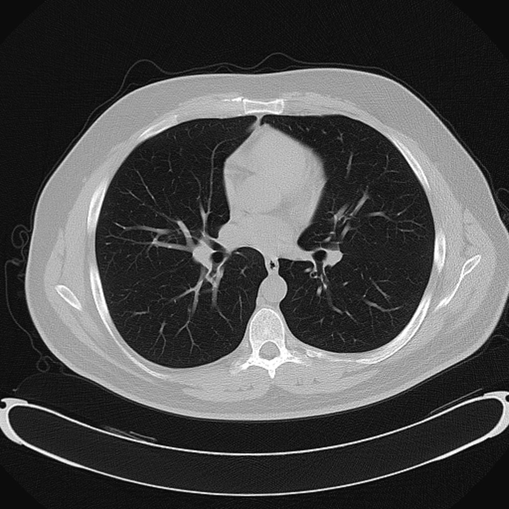 AI-Assisted CT Analysis Confirms Hypertonic Saline Slows Mucus Plugging in Cystic Fibrosis Children