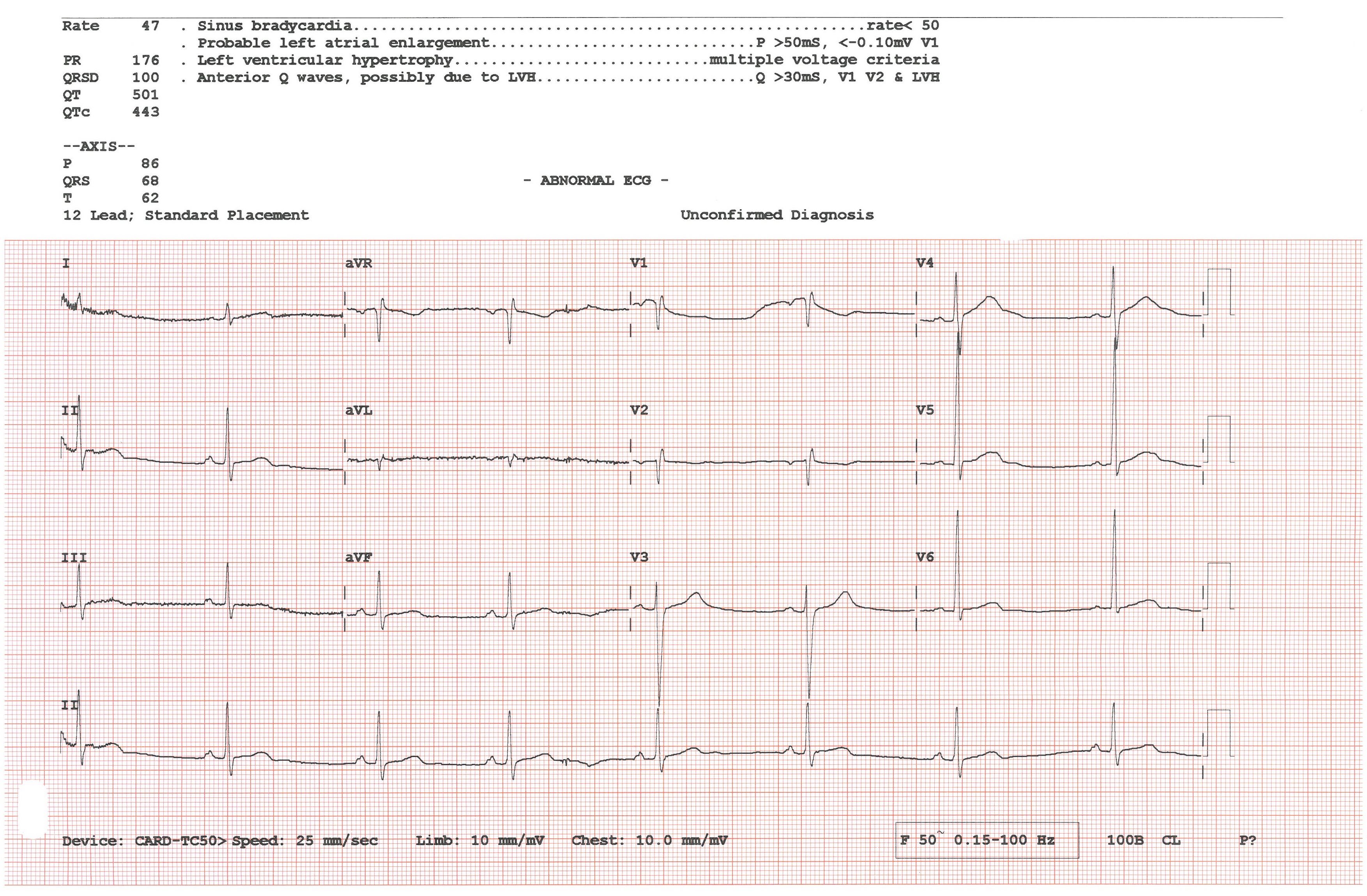 British AI System Reads ECGs in Two Seconds, Detects Hidden Heart Disease
