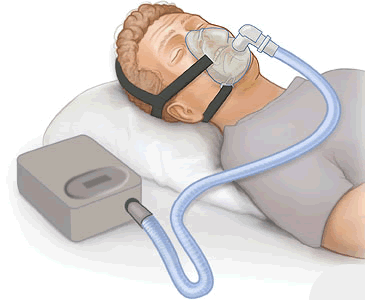 AI Chatbots Wrongly Reassure One in Three Sleep Apnea Patients